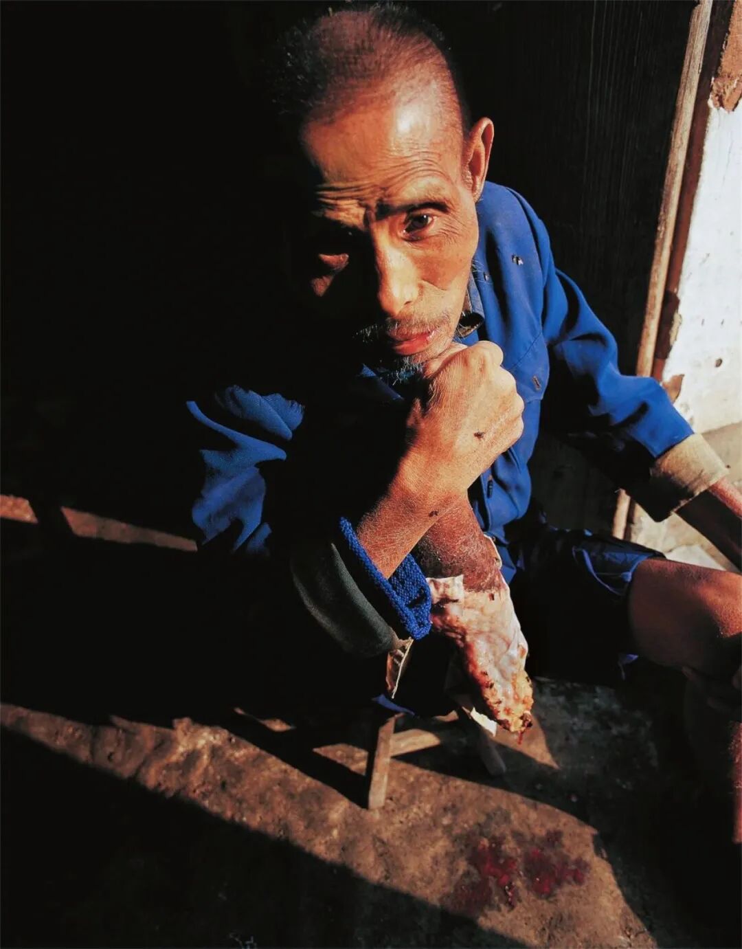 2002年李晓方在金华市婺城区白龙桥镇，见到了日军细菌战幸存者华庆云，他的右腿刚烂断。图/李晓方摄